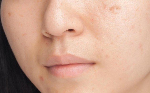 Chăm sóc đúng cách sau khi nặn mụn để làn da nhanh hồi phục